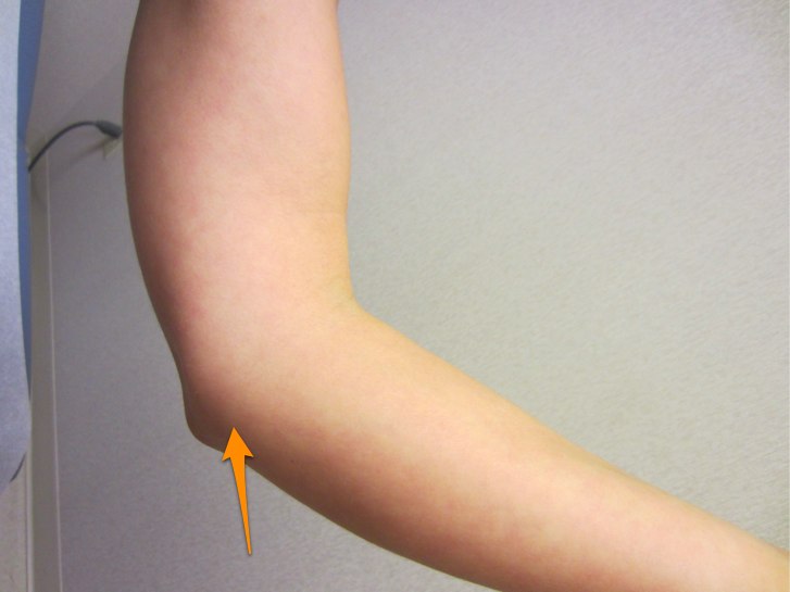 Ulnar Collateral Ligament Injuries (“Tommy John Surgery ...