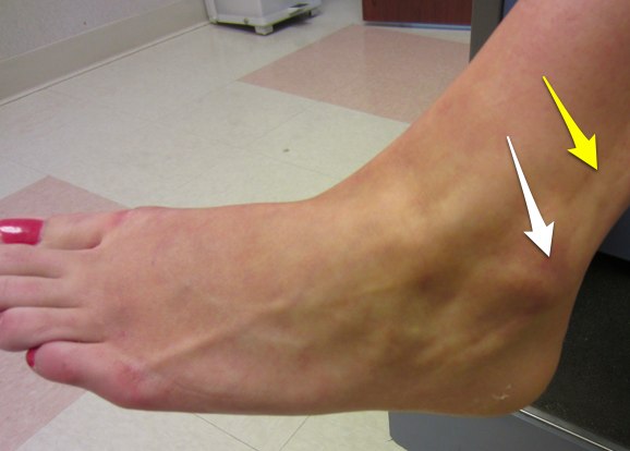 Ankle Fractures Dr David Geier Sports Medicine Simplified