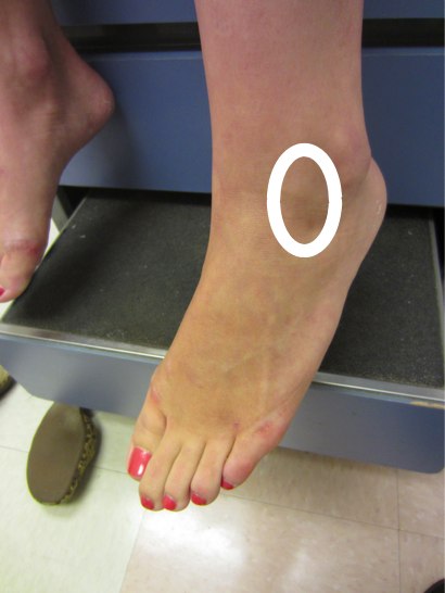 Anterolateral Ankle Impingement