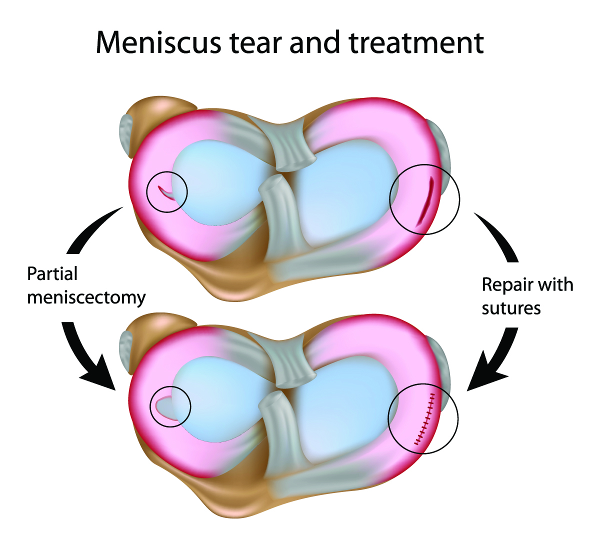 Failure Of Meniscus Repairs Dr David Geier Sports Medicine Simplified