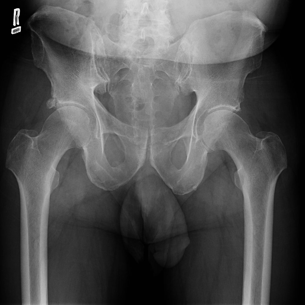 complication-rates-from-hip-arthroscopy-might-be-higher-than-initially