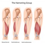 Hamstring Tendon Split Hamstring tendon tear | Dr Geier