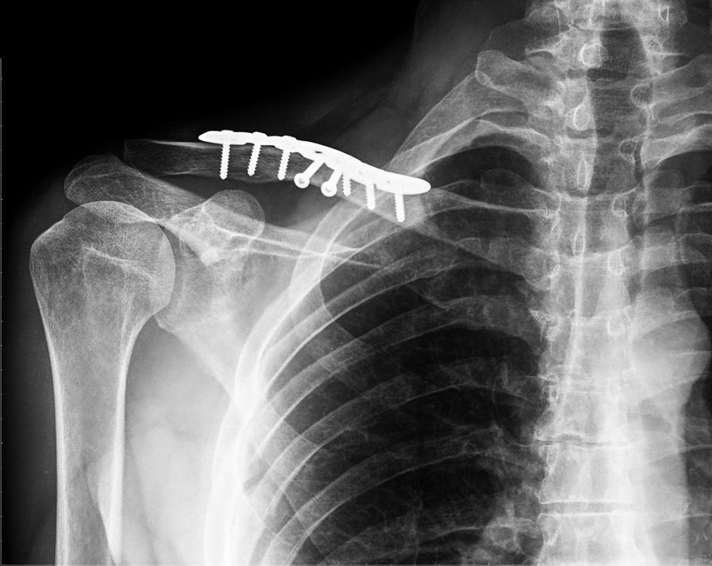 Clavicle fracture: Mechanism of injury, diagnosis and treatment | Dr Geier
