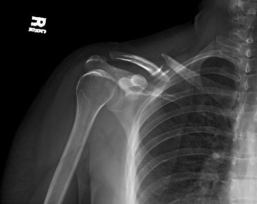 Clavicle fracture: Mechanism of injury, diagnosis and treatment | Dr Geier