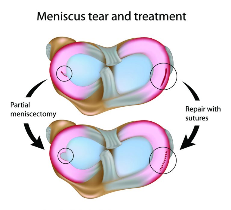 Is it possible to replace a trimmed meniscus tear? Dr. David Geier