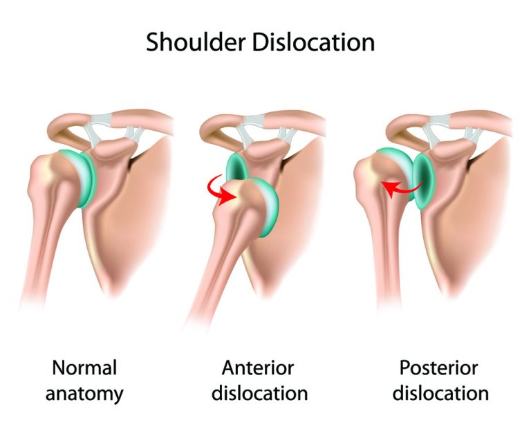Shoulder dislocations Initial management and treatment Dr Geier