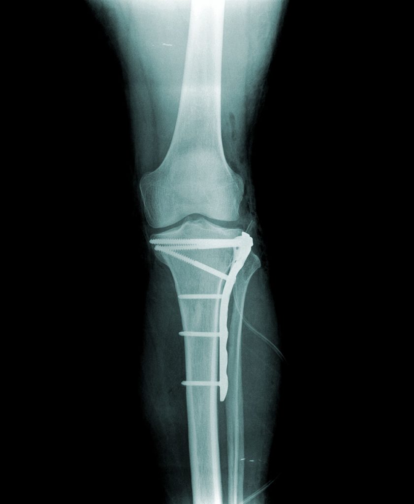 Tibial Plateau Fracture | Dr Geier