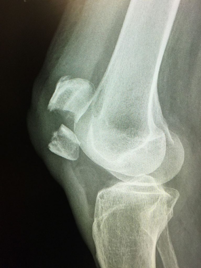 Patella fracture: Mechanism of injury, signs and symptoms and treatment | Dr Geier