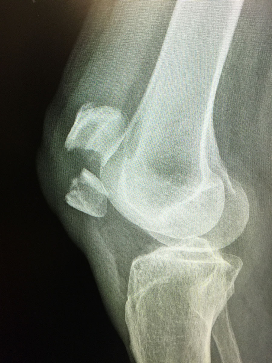 Patella fracture: Mechanism of injury, signs and symptoms and treatment