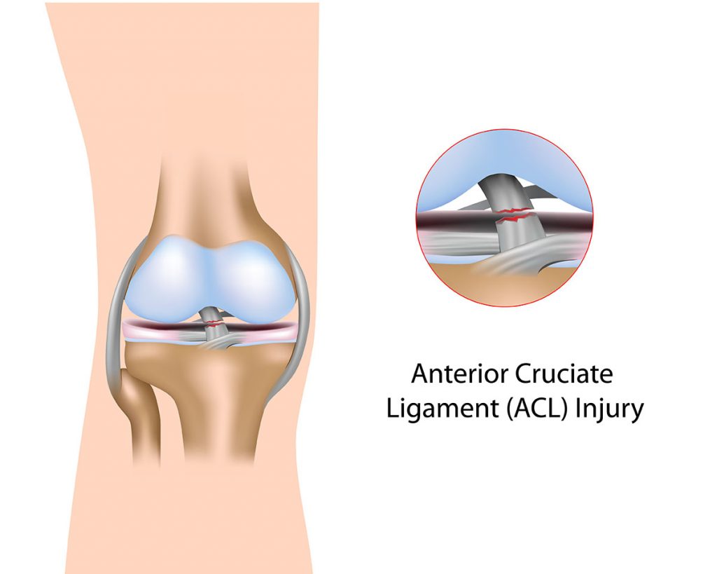 Why is it hard to play soccer with a torn ACL? Dr Geier