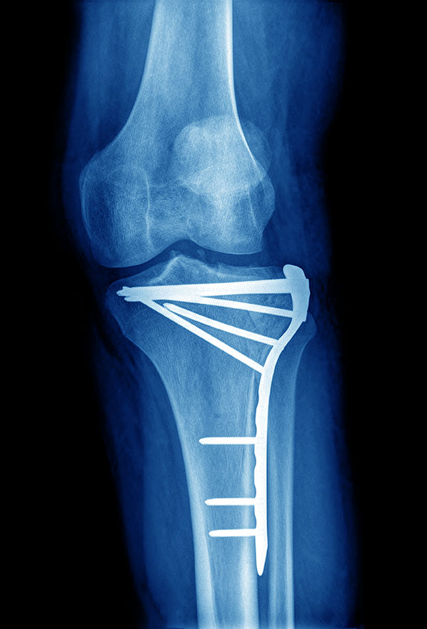Can I play sports with a plate and screws in my leg? Dr Geier