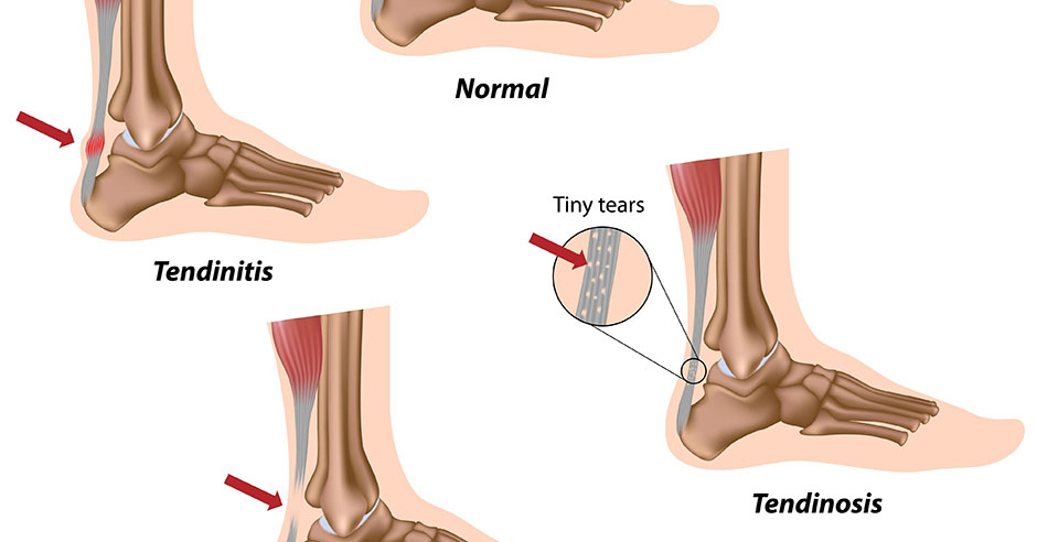 Achilles Tendinosis And Tendinitis Signs Symptoms And Treatment Options Dr Geier