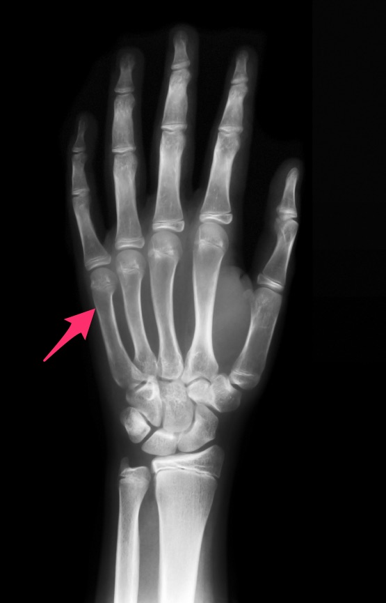 Can a boxer's fracture involve a finger other than the pinky? Dr Geier