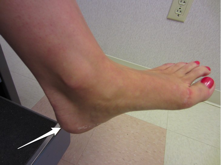 Sever’s disease Signs, symptoms and treatment options of this heel