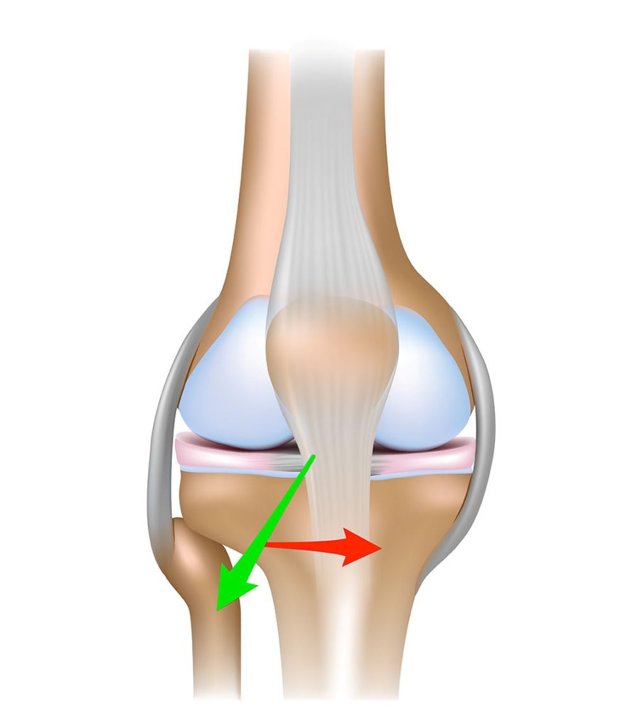 how-can-you-tell-if-you-tore-your-patellar-tendon-dr-geier